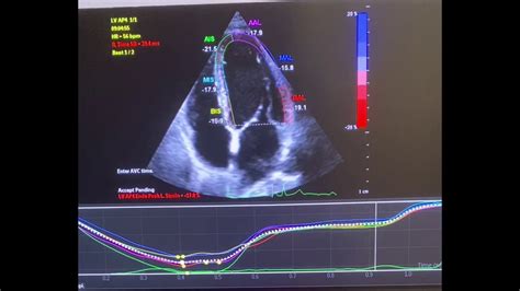 strain imaging echocardiography